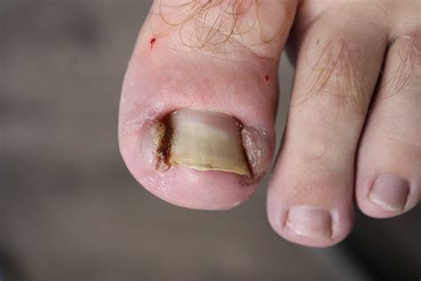 5 Ways Nail Techs Can Help With Ingrown Toenails