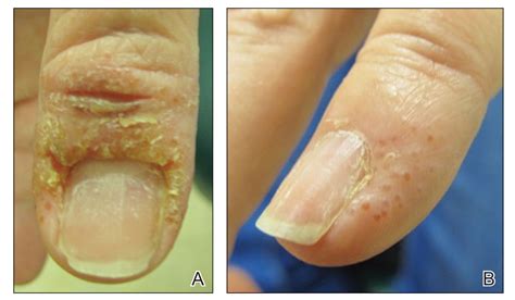 5 Ways To Prevent Contact Dermatitis As A Nail Tech