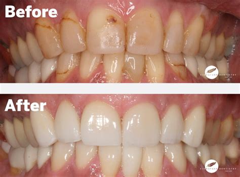 7 Tips For Becoming A Certified Veneer Tech