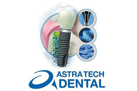 Astra Tech Implants: Revolutionizing Dental Restoration