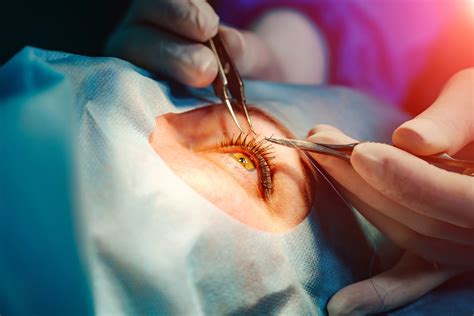 Mastering Ophthalmology Surgical Tech For Eye Care Excellence